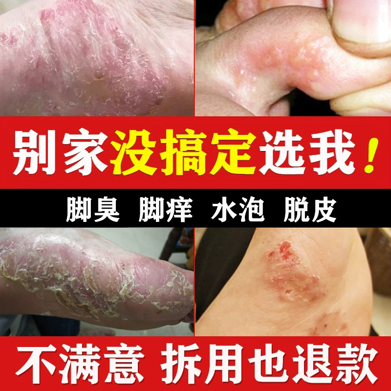 去脚痒脚臭气干裂脱皮脚汗喷雾止痒膏克星起水泡烂丫神器护理
