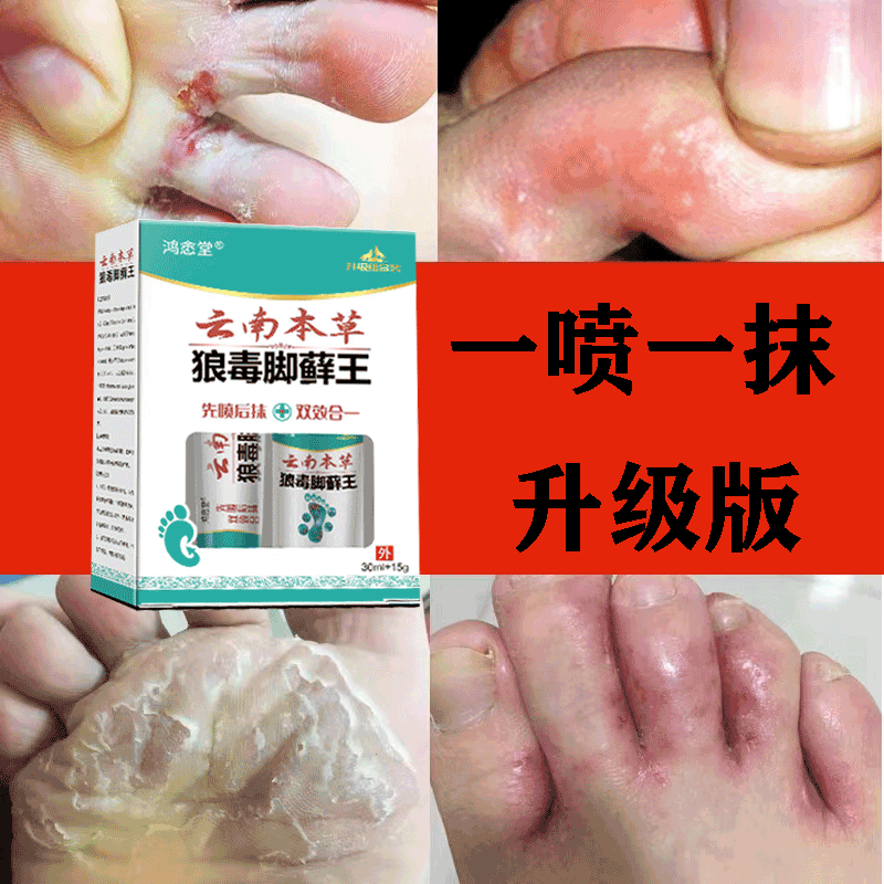 脚痒脱皮烂脚丫喷剂膏云南本草喷雾剂脚底干裂脚水泡脚臭痒的克