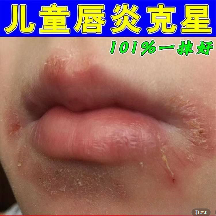 秋冬儿童舔嘴唇红嘴圈干裂脱皮嘴巴一圈红上火起泡烂嘴角专用软膏