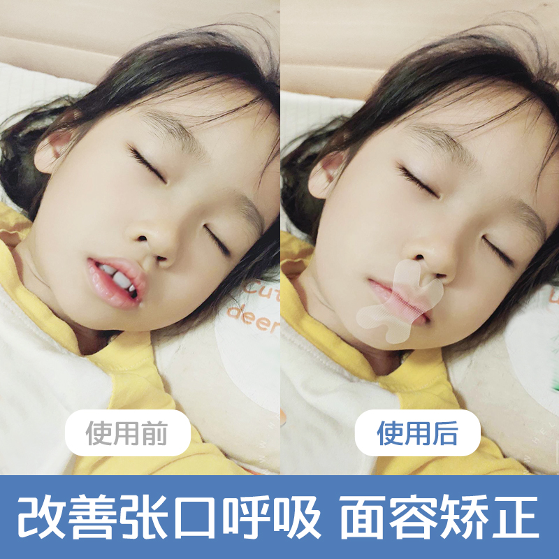 嘴巴封口贴闭嘴神器防张嘴口呼吸矫正器睡觉防张嘴贴嘴巴呼吸矫正