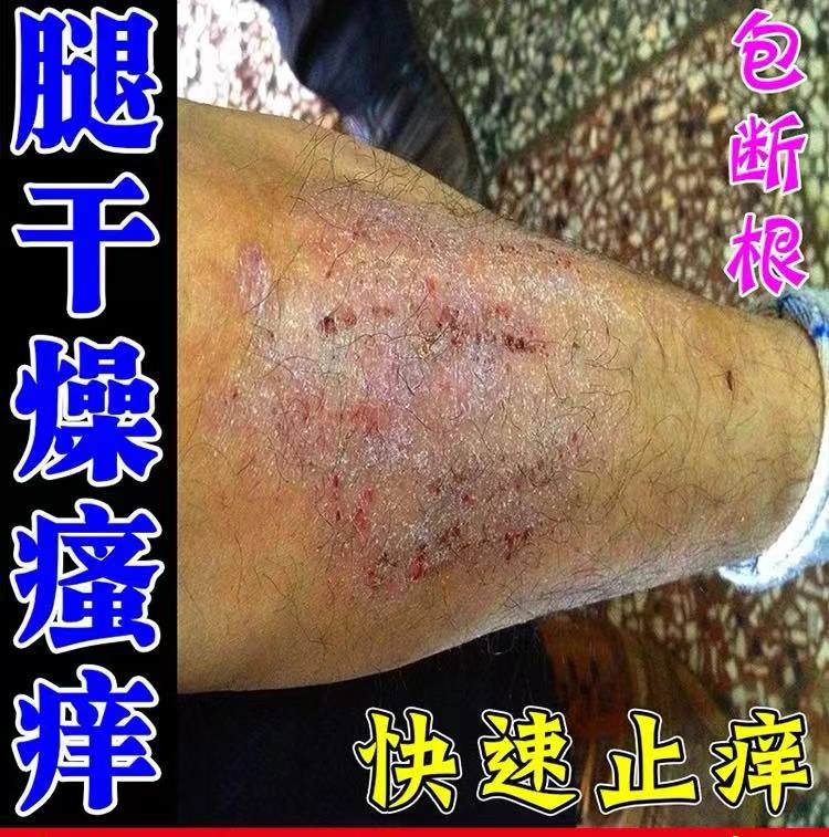腿上干燥起皮小腿皮肤痒止痒膏秋冬腿部长疙瘩越抓越痒抑菌软膏