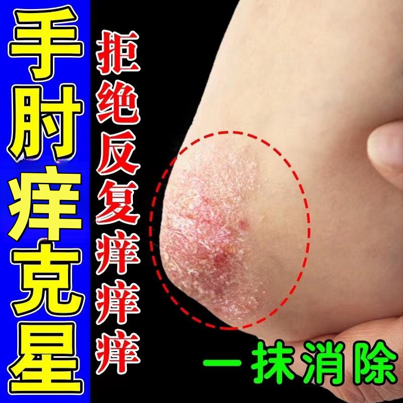 手肘痒胳膊肘手臂痒肚皮后背腰间痒头皮痒腿上干燥起皮专用止痒膏