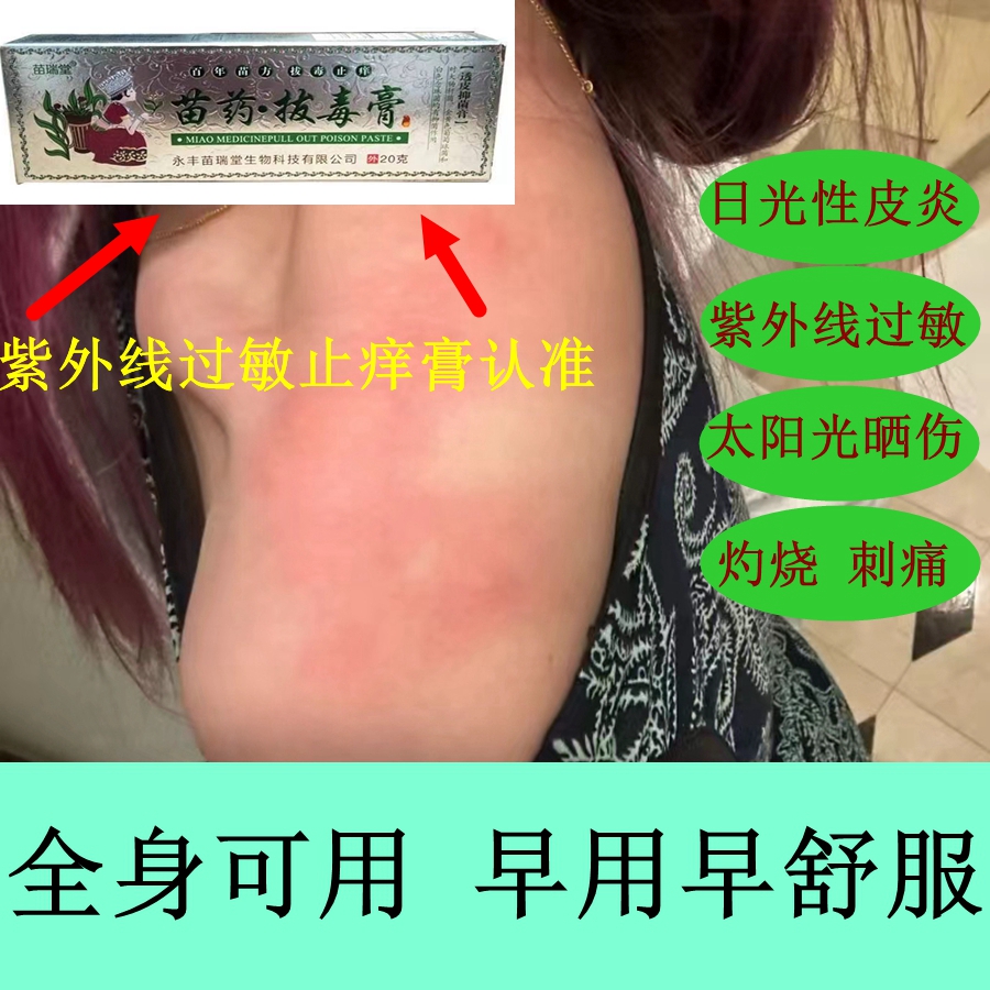 苗瑞堂紫外线过敏止痒膏拔毒止痒专用皮炎太阳晒伤日光性抑菌乳膏