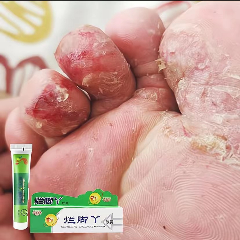 【老一辈人的方子】烂脚丫真菌王止痒快克皮肤抑菌膏止痒膏草本乳
