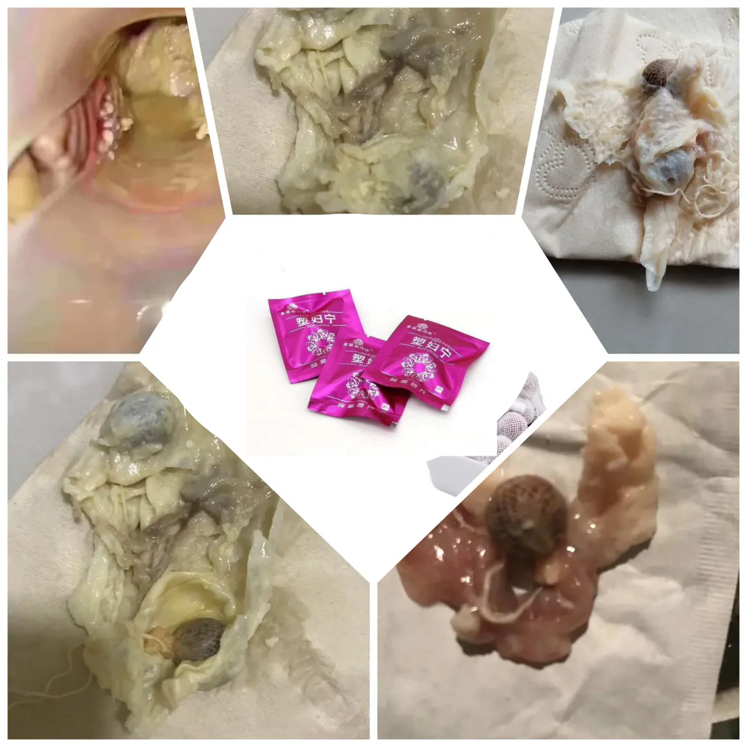 【去异味】清宫丸正品拉线抑菌养巢阴毒排丸女性私密保养清洗液