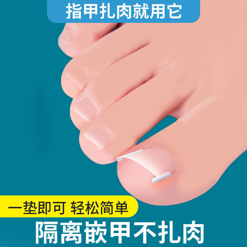 甲沟炎矫正神器足浴店专用脚趾矫正器大脚趾往肉里长填充垫隔离垫